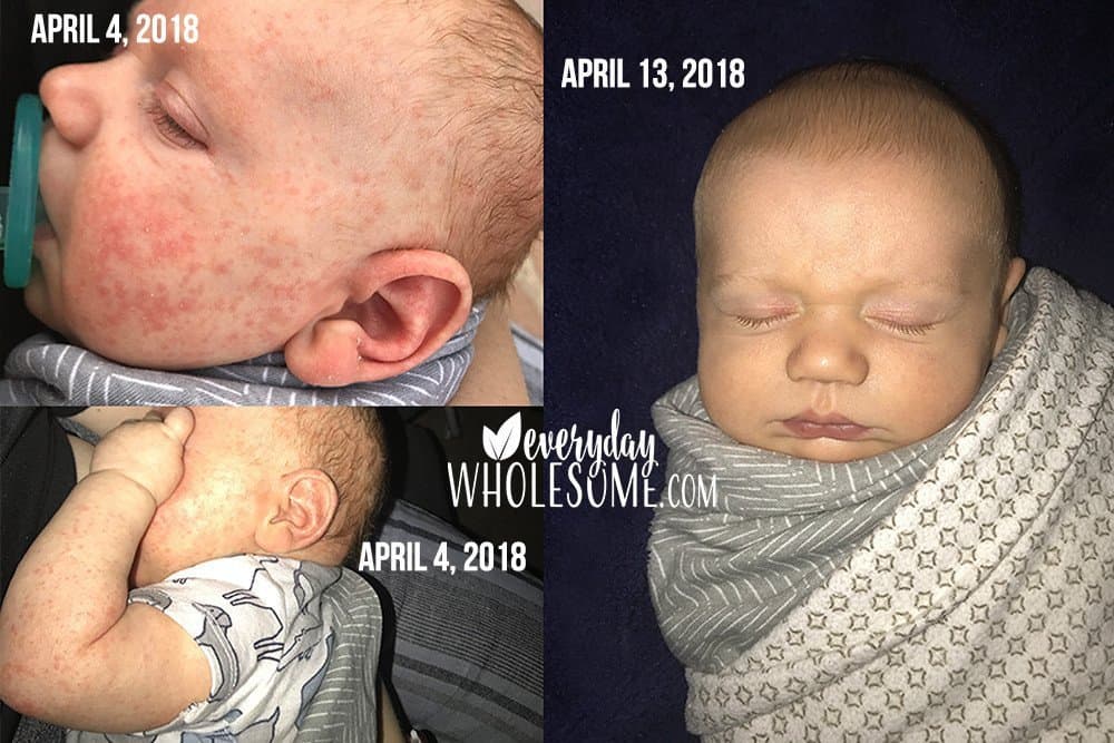 before after baby rash